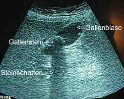 Gallenblase mit Gallenstein im Ultraschallbild