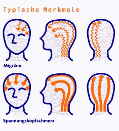 Kopfschmerzen und Migräne: Typische Merkmale